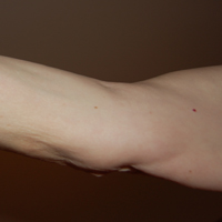 artritis