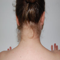 cervicalgia