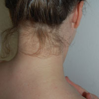 cervicobraquialgia