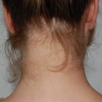 herniacervical