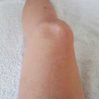 rehabilitacion-rodilla