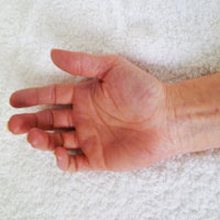 sindrome-del-tunel-carpiano