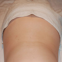 sindrome-del-piramidal