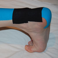tendinitis-aquiles