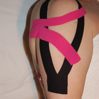 tendinitisbiceps