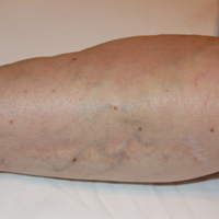 varices